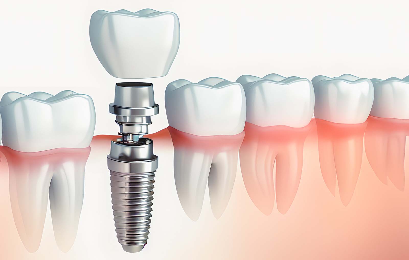 Dental implants Narsingi Gandipet Hyderabad – single tooth full arch All-on-4