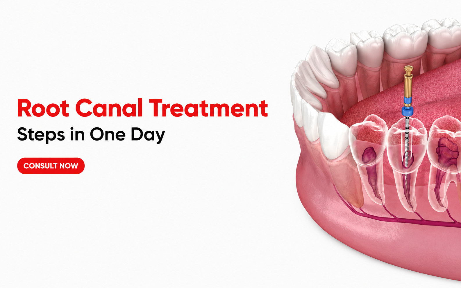 Dental crowns bridges root canal Narsingi