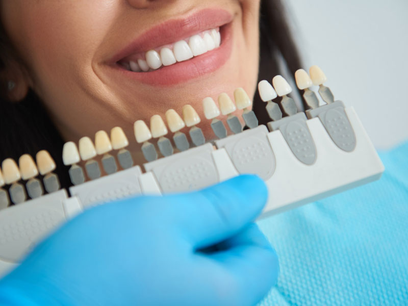 Smile makeover consultation